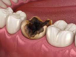 restorative dentistry molar