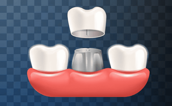 Dental Crown