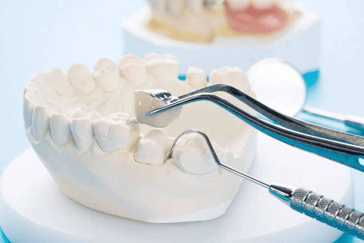 Dental Crowns