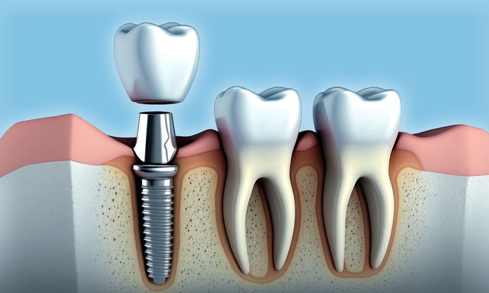 Dental-Implants-Near-Me-Vista