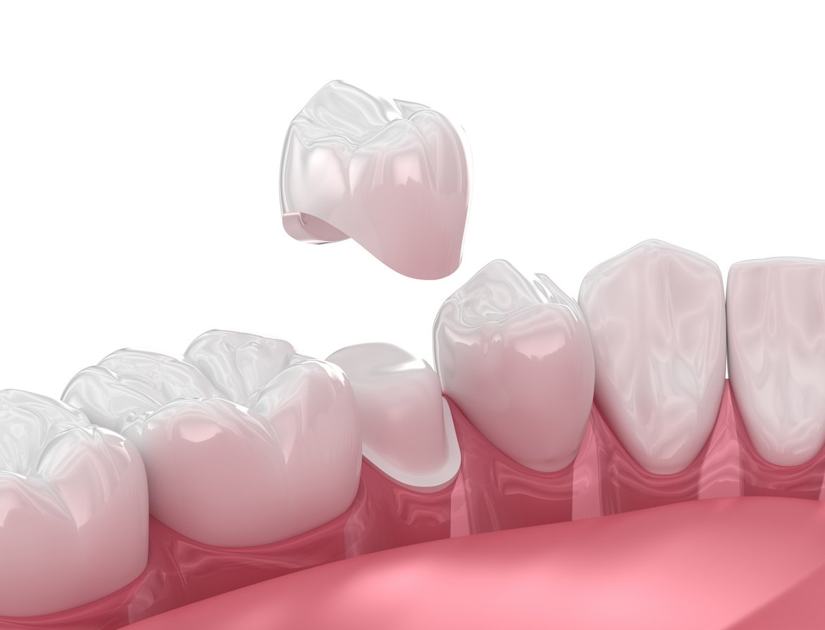 Dental-crowns-for-broken-cusps