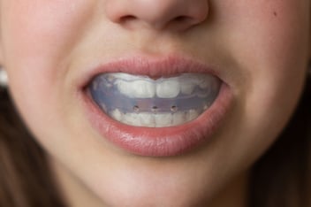 Invisalign dentist in Ventura