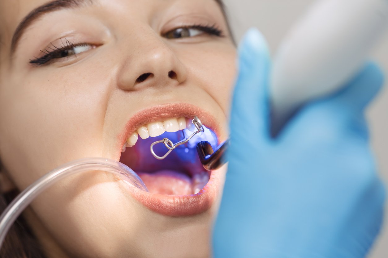 Restoring-your-smile-with-dental-bonding