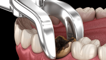 Tooth Extraction