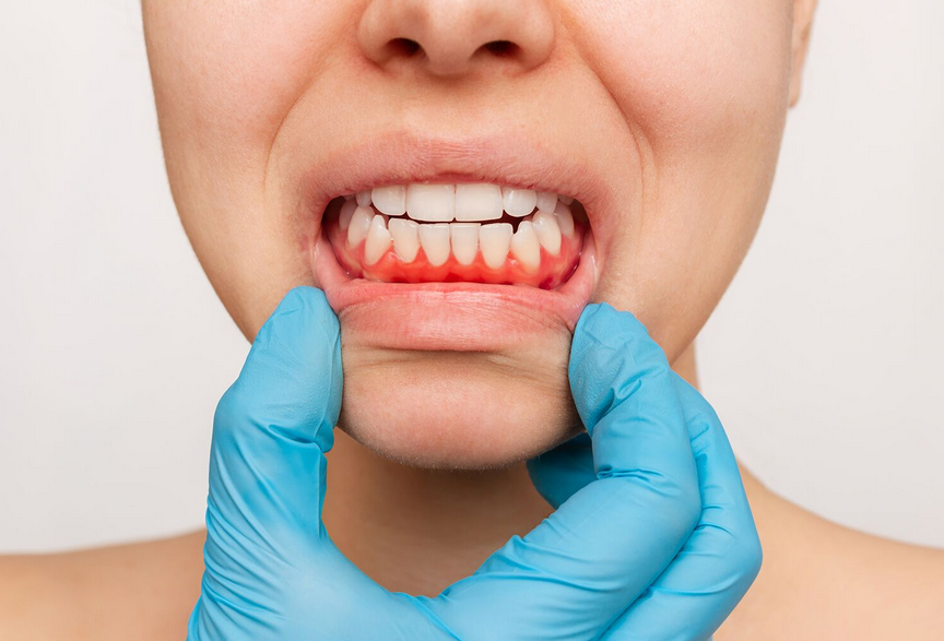 Screenshot 2025-03-10 at 13-20-20 Drupal-NEWS_Gum-disease-stages.jpg (JPEG Image 1546 × 1056 pixels) — Scaled (58%)-1