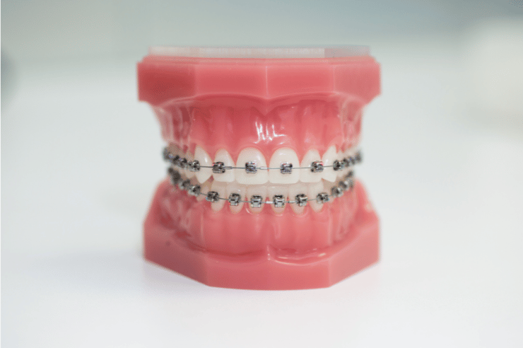 Braces / Orthodontics Dental