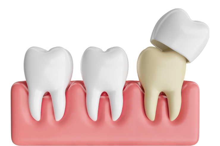 Dental Crowns in Ventura County