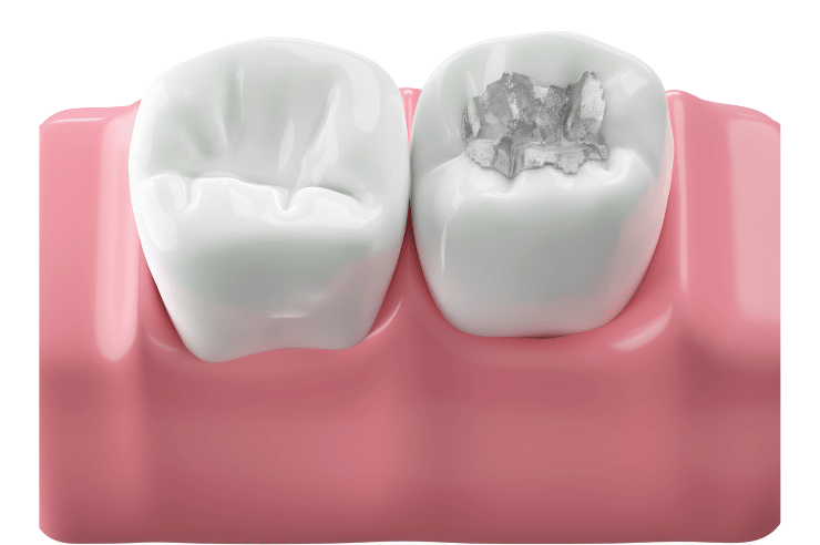 Dental Sealants in Ventura 