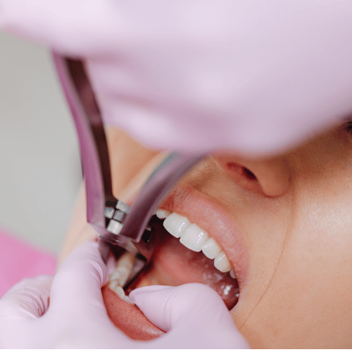 Teeth Extractions