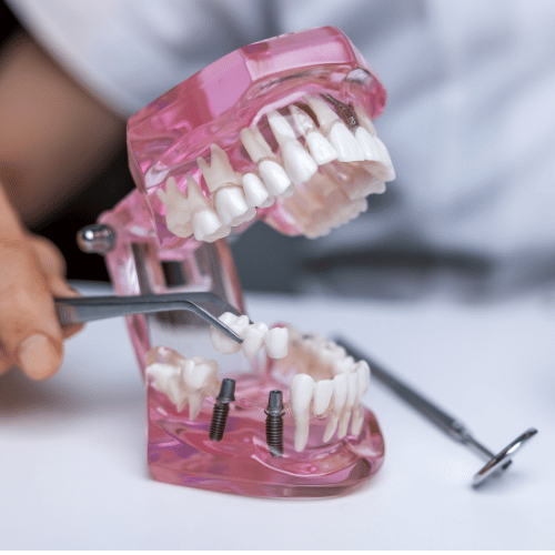 Tooth Bridges Dentists 