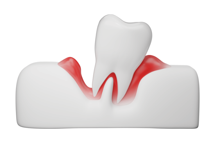 Gum Disease in Ventura County