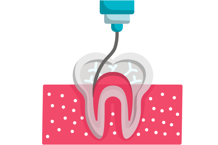 Root Canal in Ventura County