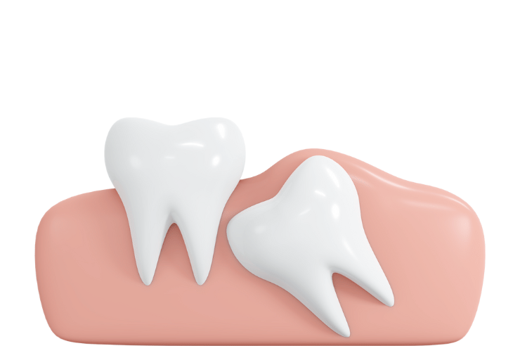 Wisdom Teeth in Ventura County