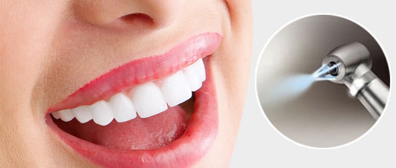 air-flow-polisher-in-ealing-dental-hygienist-in-ealing