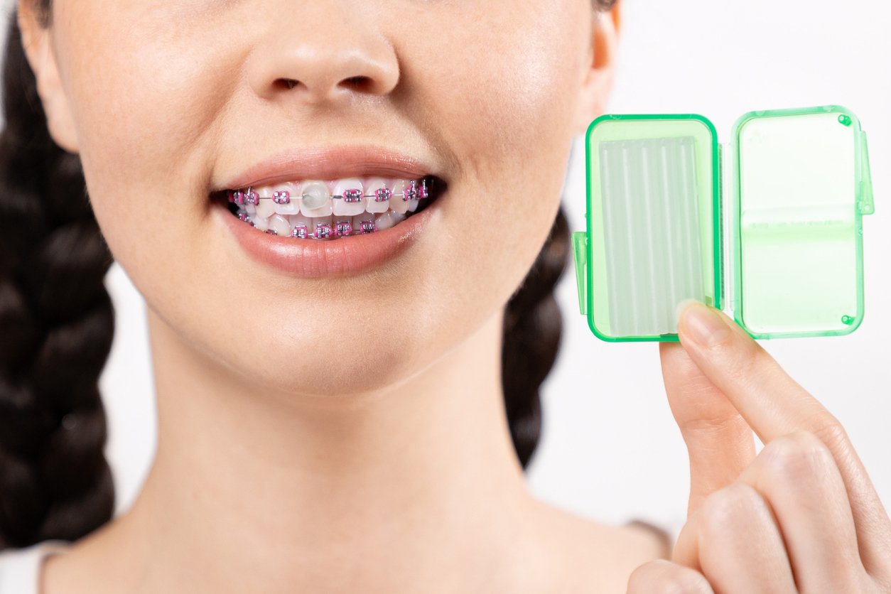 braces-pain-relief-with-orthodonttic-wax