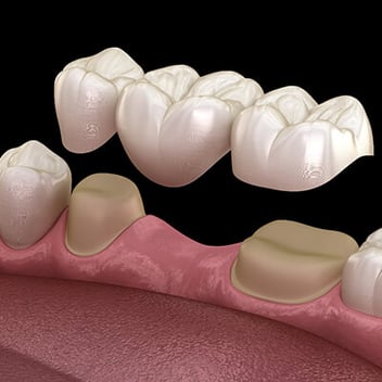 Dental Bridges