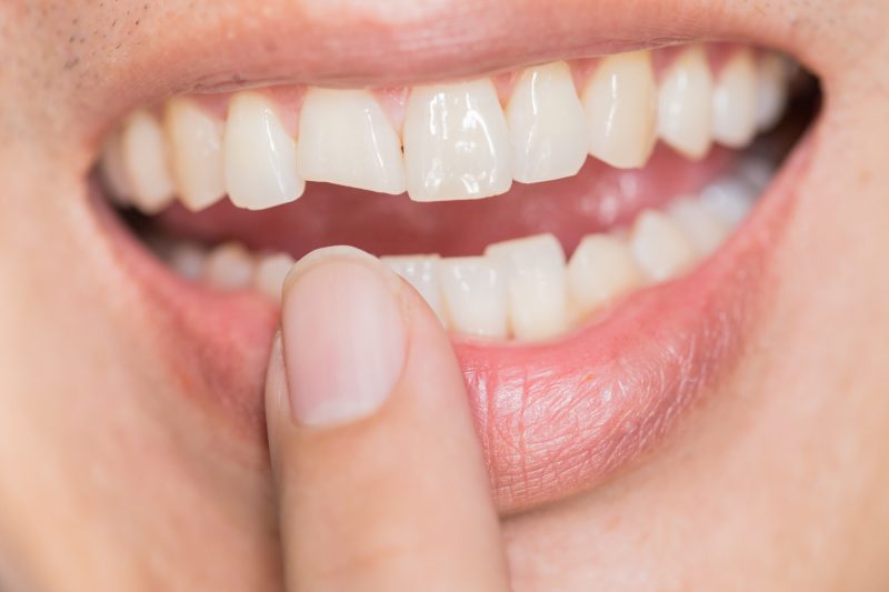 chipped-tooth-e1574619451968
