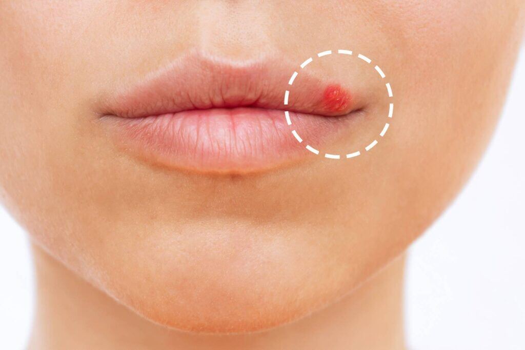 close-up-herpes-lip-blisters-mouth-young-woman-1-1024x682