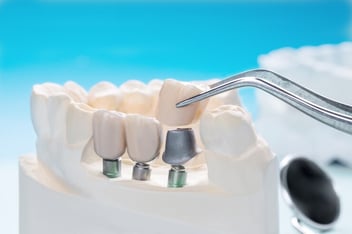 Dental Implants in Camarillo