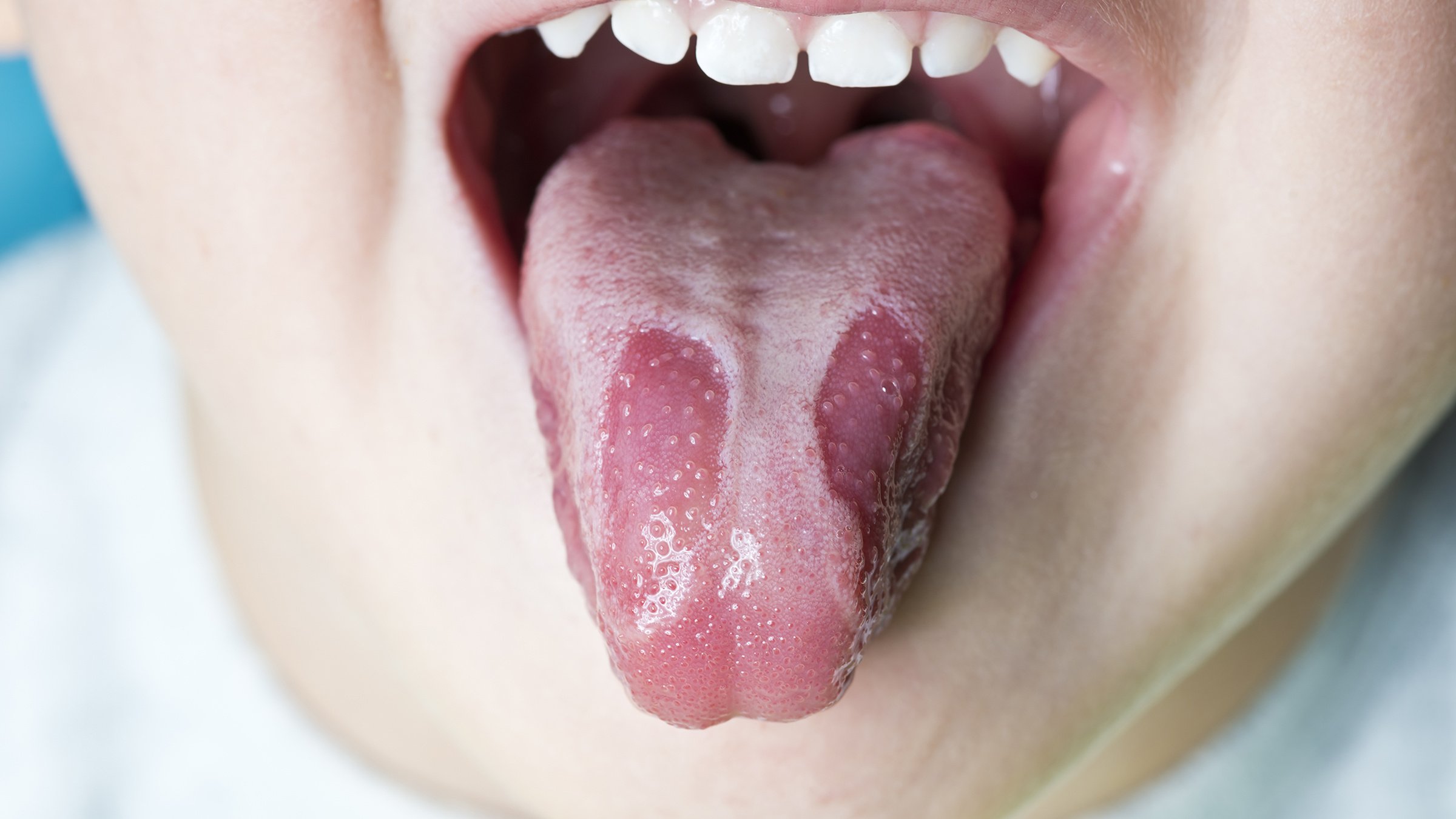 closeup_child_geographic_tongue_487693947