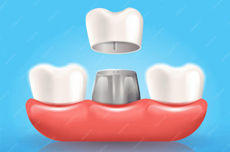 dental Crowns in ventura 