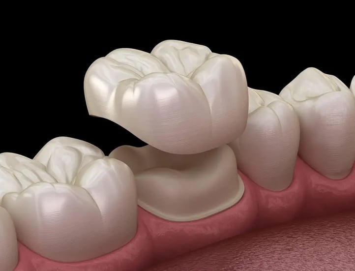 dental-crown-scaled