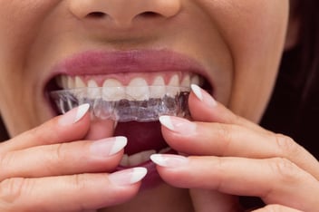 Invisalign cost Thousand Oaks