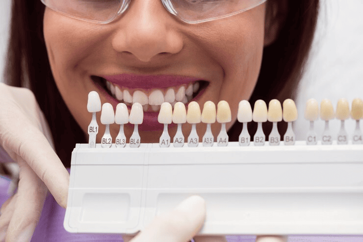 Porcelain Veneers