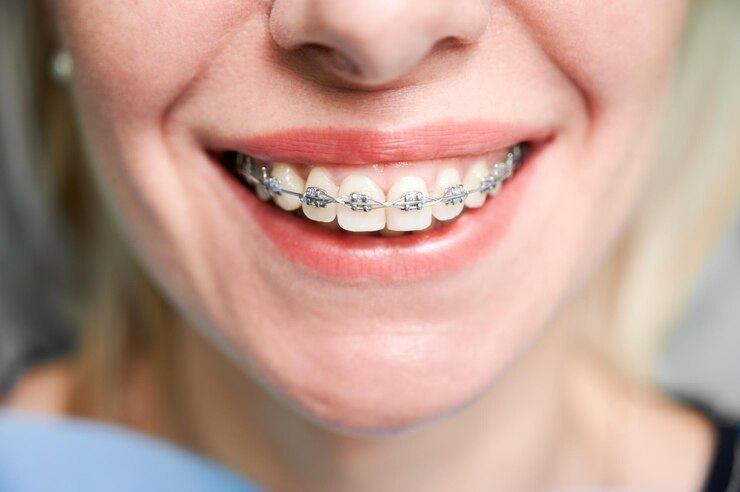 Metal Braces in Ventura