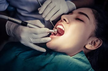 dental bridges in Oxnard