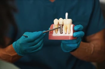 Dental implants in Oxnard