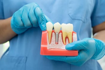 dental implants in Thousand Oaks