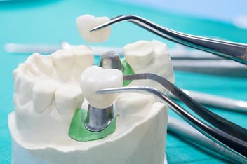 dental crowns in Camarillo