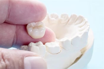 Dental Crowns Beverly Hills