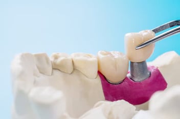 dental crowns in Ventura