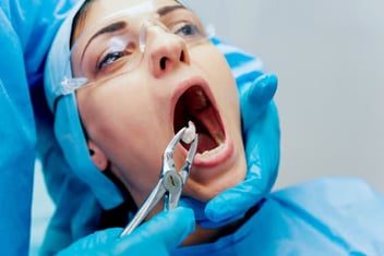 wisdom teeth removal in ventura