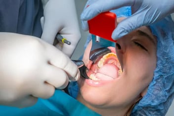 Wisdom Teeth Removal