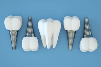 Dental implants