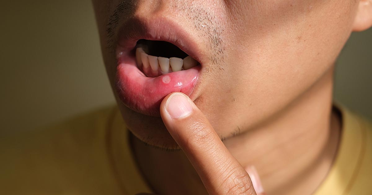 man-lip-sore-1200x628