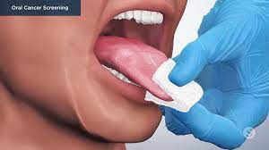 oral cancer swab