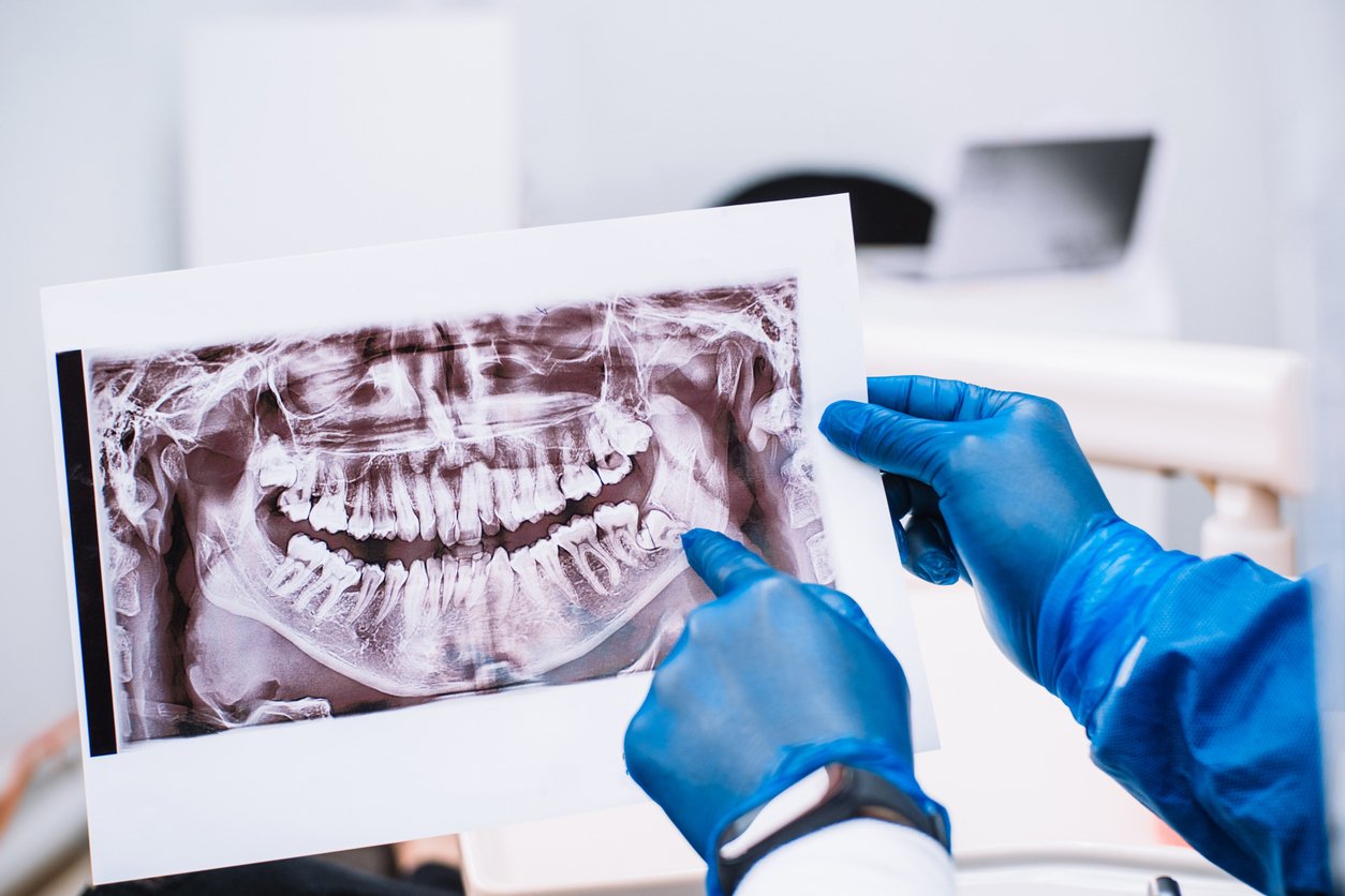 proactive-wisdom-tooth-removal