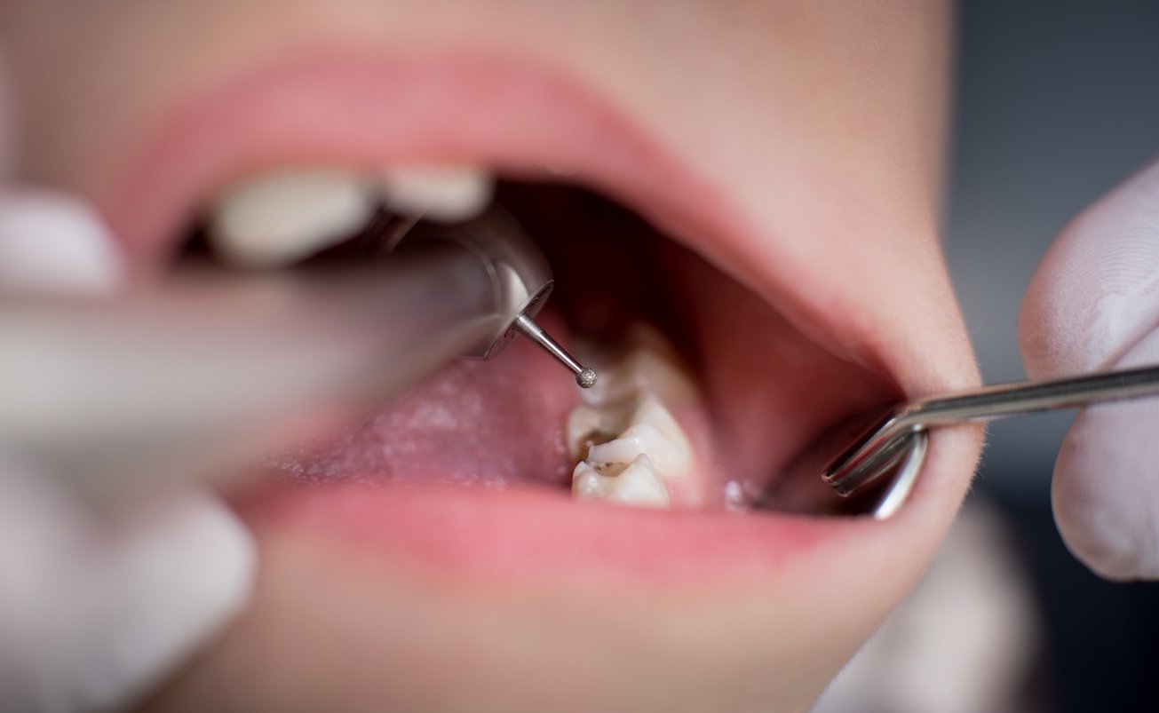 tooth-sensitivity-after-dental-fillings