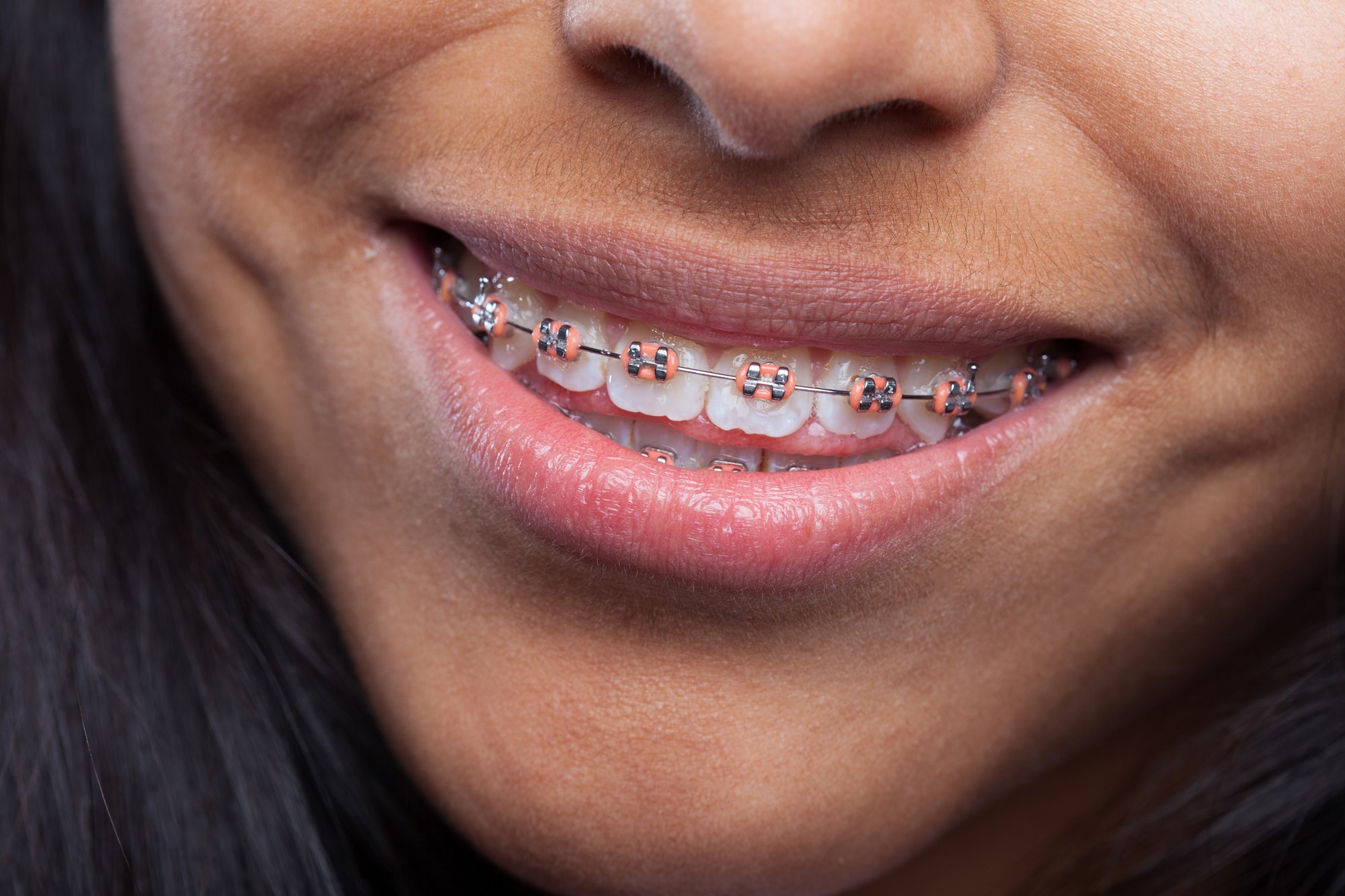 woman-smiling-with-teeth-apparatus