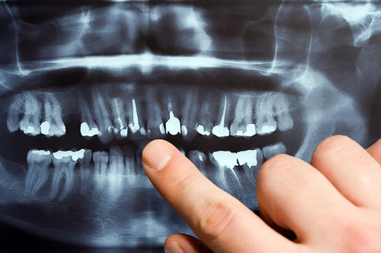 x-ray image of teeth