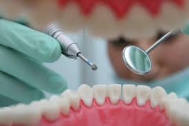 advanced teeth cleaning