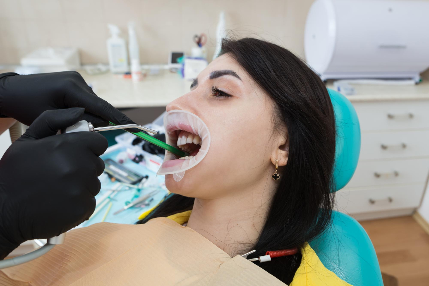 teeth cleaning in Camarillo
