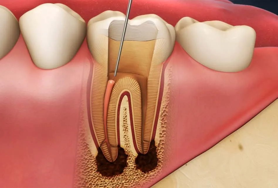 Root canal