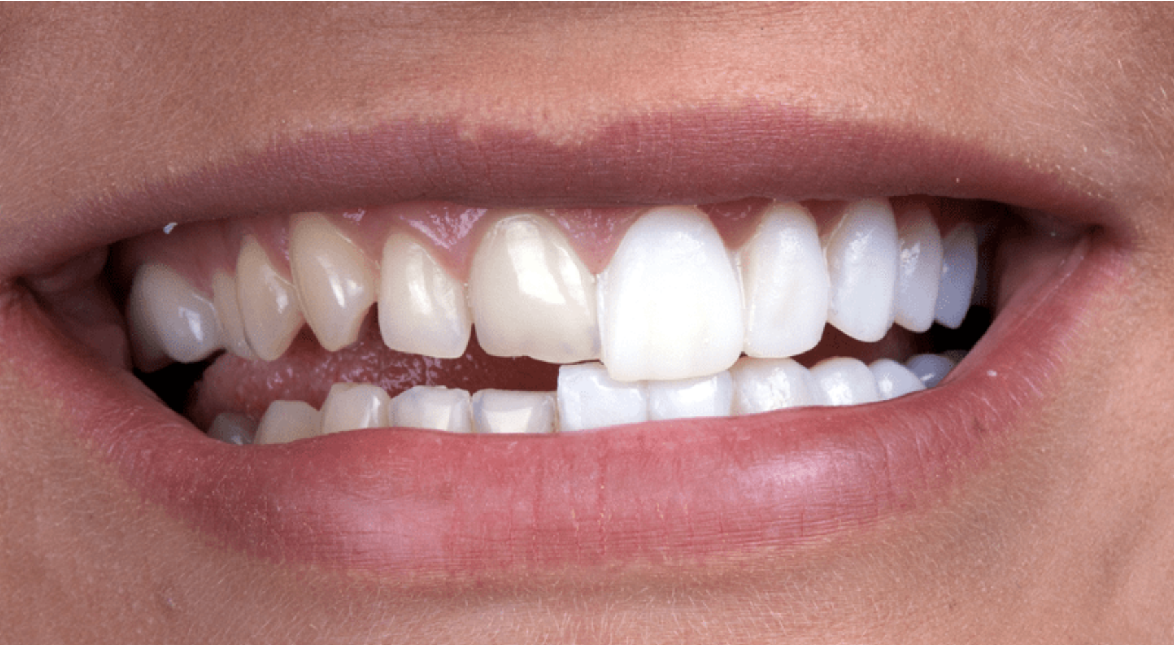 Invisalign: Straighten Your Teeth Discreetly