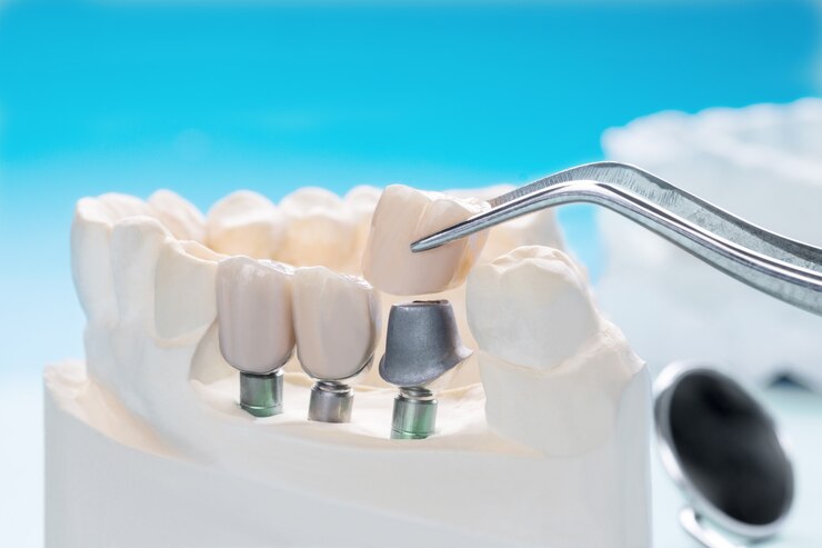 Dental Implants in Camarillo