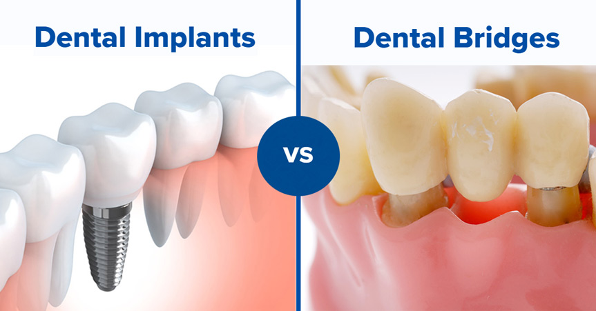Dental Bridge Versus Dental Implant: Understanding the Difference